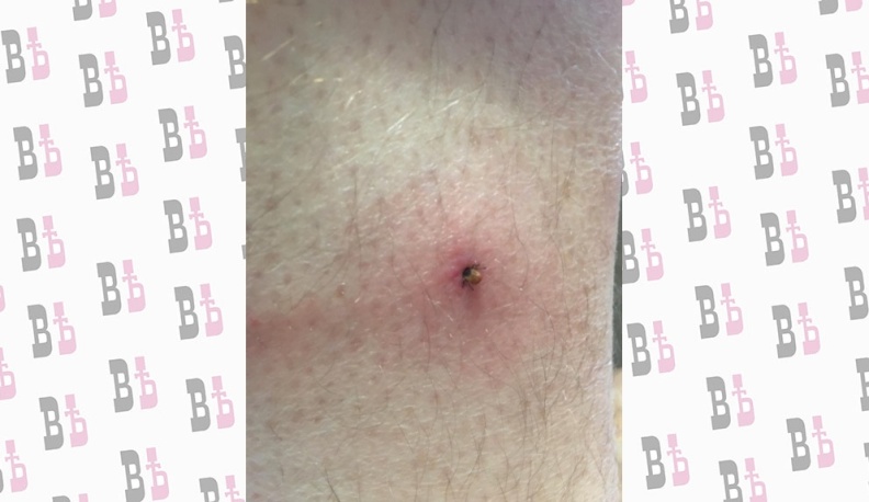 За неделю клещи покусали 67 калужан