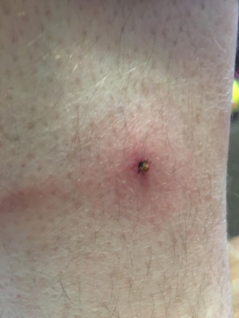 Клещ 2.jpg Клещ 2.jpg