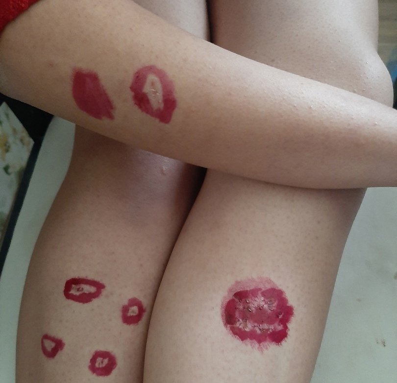 Последствия нападения собаки.jpg